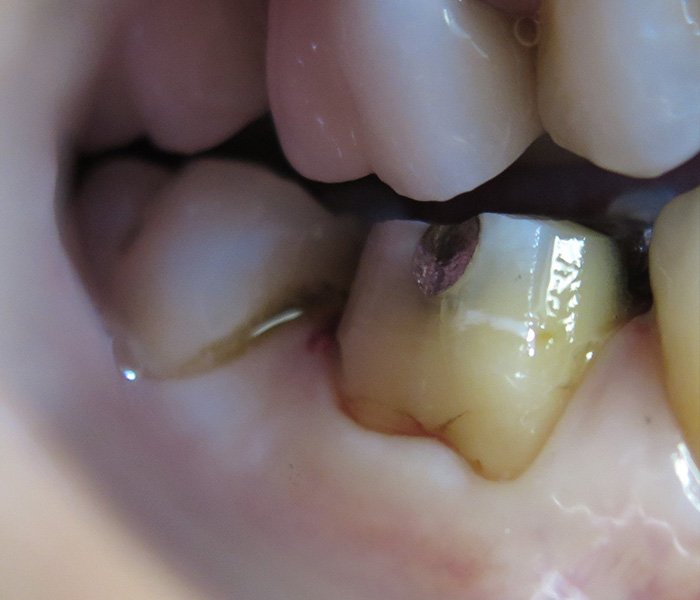 Dental Crowns Before