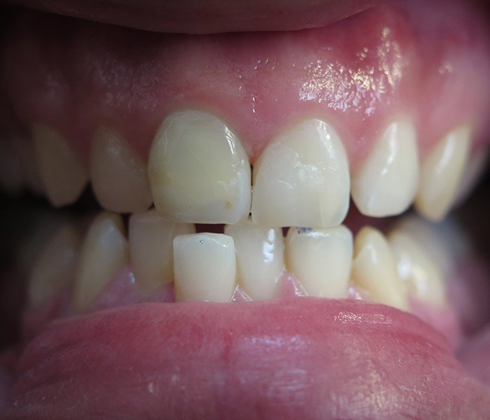Composite Fillings After