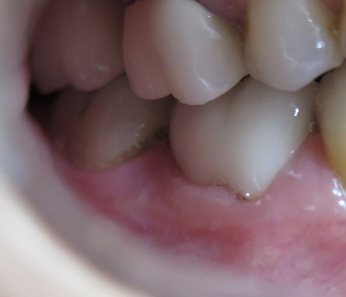 Dental Crowns After