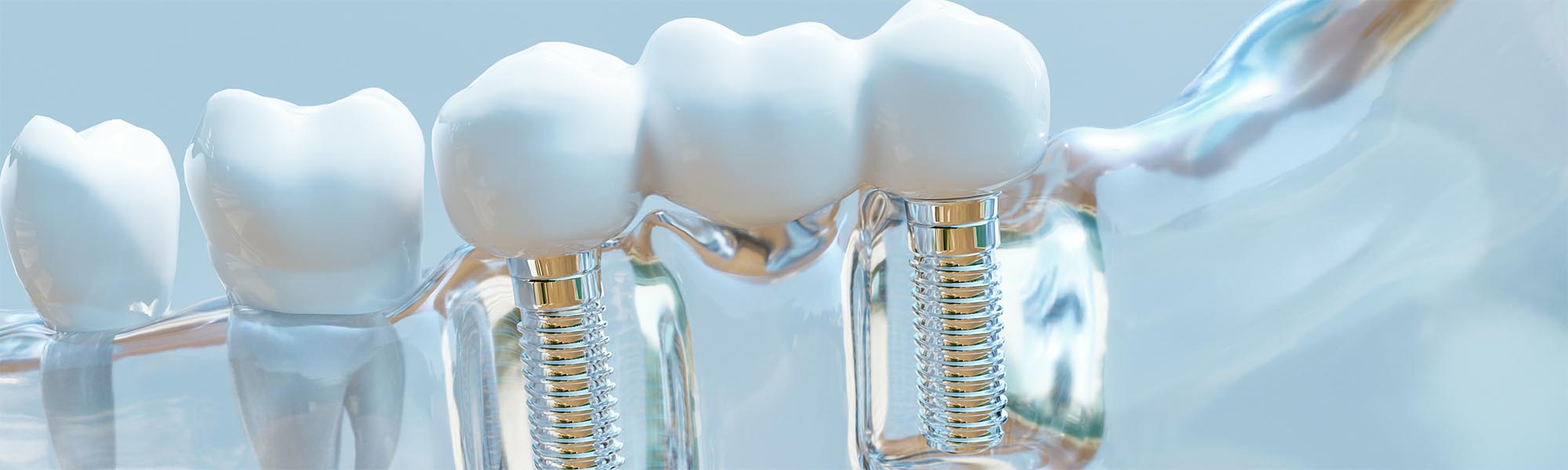 Dental Implants Benefits in Carson CA