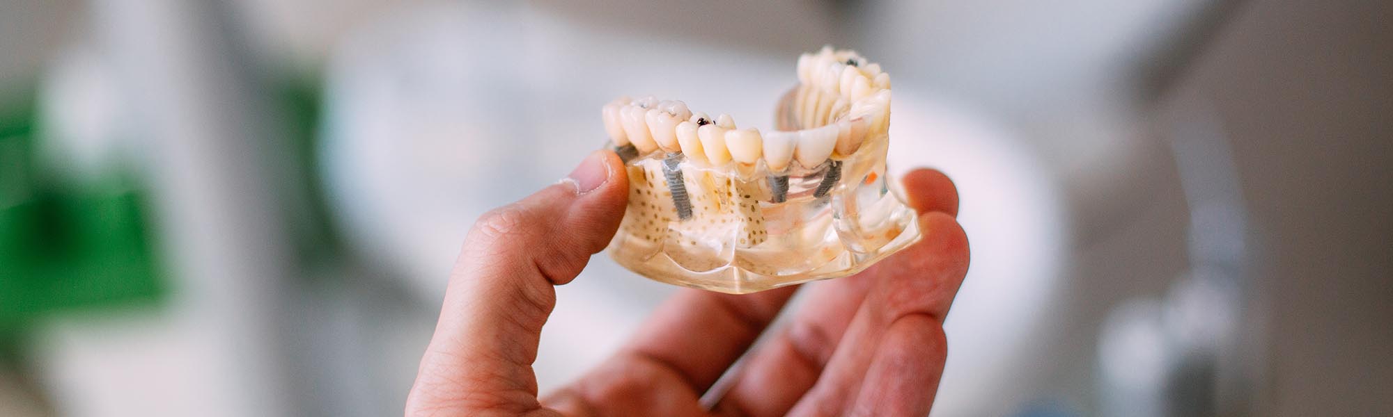 Multiple Teeth Implants in Carson CA
