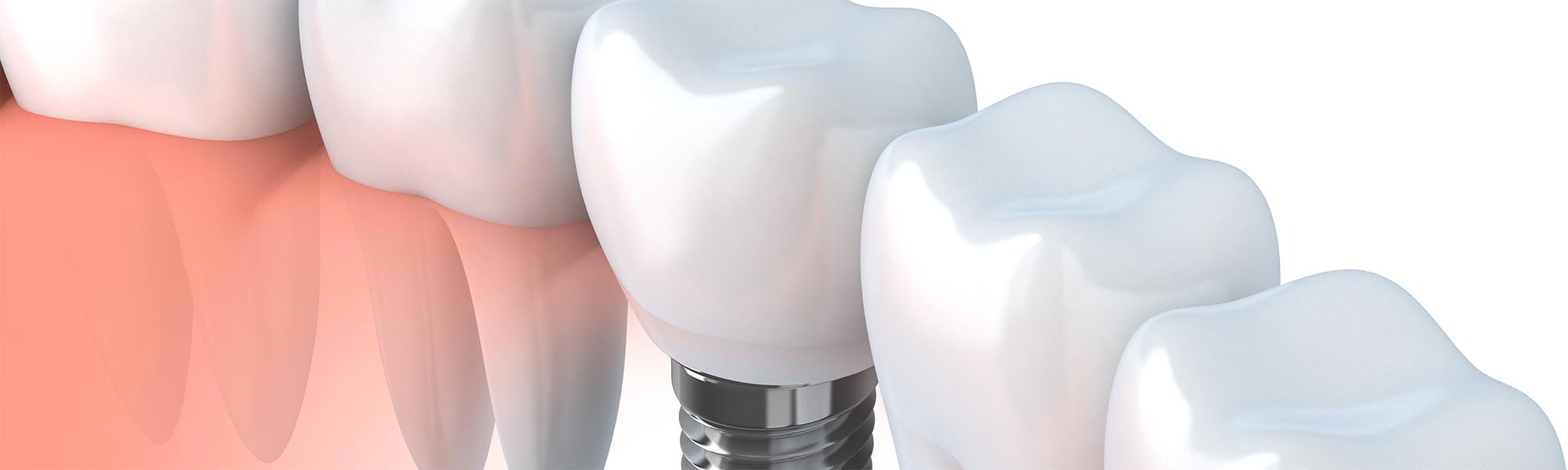 Single Tooth Implants Carson CA